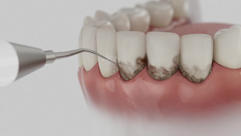 Reliable Dental Implants contractor in Lapel, IN by Smile Center Dentistry
